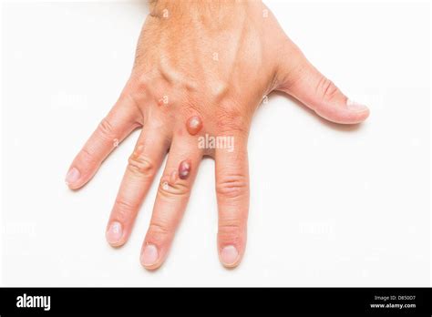 Mans Hand Covered With Blisters Caused By Cryosurgery Wart Removal
