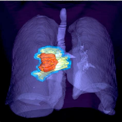 Example Of A Ct Image Of A Patient Suffering From Non Small Cell Lung