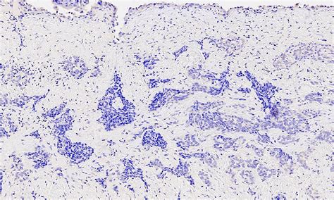 The distinction between epithelioid mesothelioma and metastatic adenocarcinoma cannot be. Pathology Outlines - Mesothelioma - epithelioid
