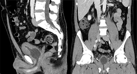Contrast Enhanced Ct Of The Abdomen And Pelvis Sagittal Left And