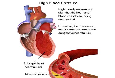 13 ways to reduce high blood pressure | ArticleIFY