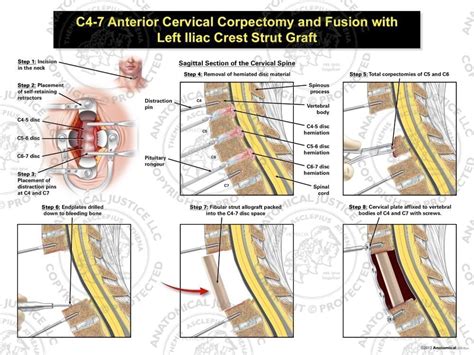 C4 7 Anterior Cervical Corpectomy And Fusion With Fibular Strut Graft