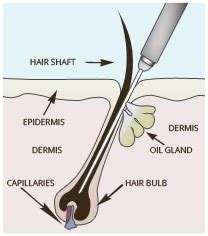 This kind of hair removal method uses an appropriate electrical current to destroy the follicle of hair. What is Electrolysis?