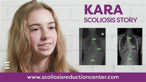 Severe Scoliosis Treatment Without Surgery Karas Story Youtube