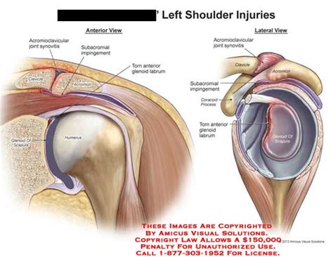 It's soft tissue that helps connect the socket part of the scapula (called the glenoid) with the head of the. Left Shoulder Injuries