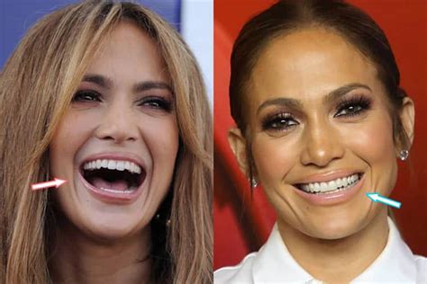 Has Jennifer Lopez Had Cosmetic Surgery Before And After 2018