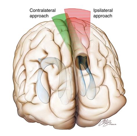 Interhemispheric Craniotomy The Neurosurgical Atlas By Aaron Cohen