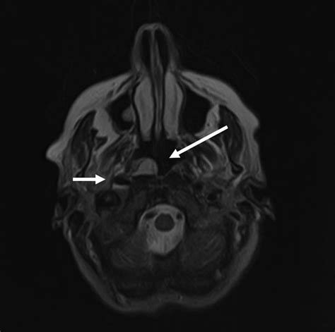 Endoscopic Marsupialization Of A Nasopharyngeal Branchial Cleft Cyst