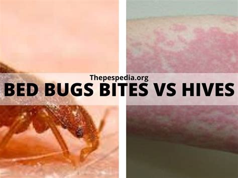 Bed Bugs Bites Vs Hives What Is The Difference In Table