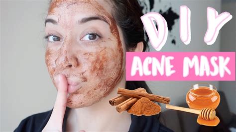 how i use honey and cinnamon for my acne acne marks dark spots large pores melasma