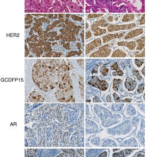 Distribution of the MA and BL tumors according to ER, HER2, GCDFP15 and ...
