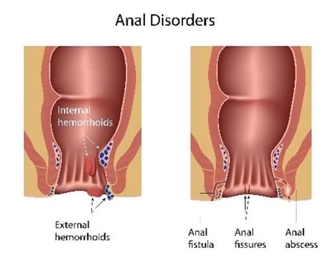 How To Tell The Difference Between Hemorrhoids And Rectal Prolapse
