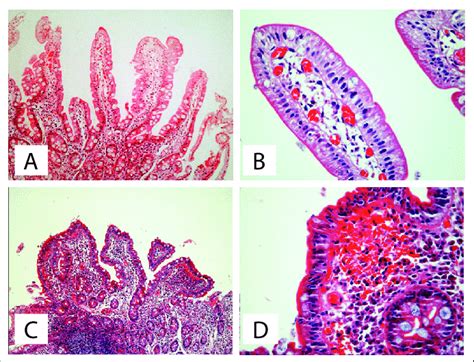 Distal Duodenal Biopsy Exhibiting Mucosa With Normal Histological