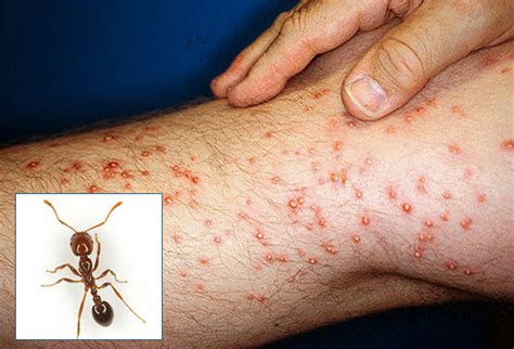 People, tv, buzz en photos. 33 Things a Doctor Needs to Know and Remember About Bug Bites