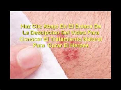 Cura Para El Herpes Genital Super Efectiva Youtube