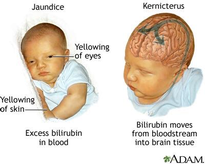 Bayi kuning atau penyakit kuning merupakan kondisi yang umum dialami bayi baru lahir. Badan Sihat Hati Ceria: Cara Turunkan Bacaan Kuning Bayi