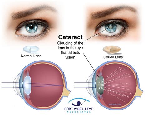 Cataracts Causes Signs Symptoms Surgery Recovery
