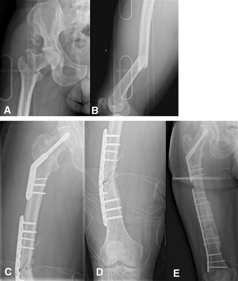 A Anteroposterior Radiograph Of The Hip And B The Femur Of A
