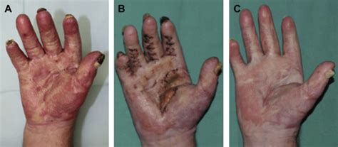 Scar Management Of The Burned Hand Hand Clinics