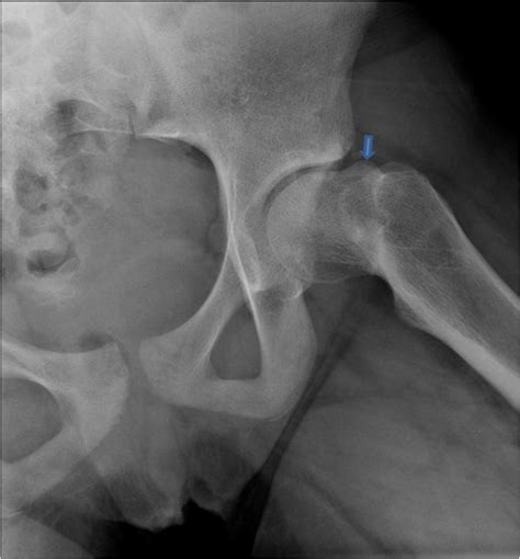 Surgical Dislocation And Proximal Femoral Osteotomy For A 12 Year Old Female With Pain After