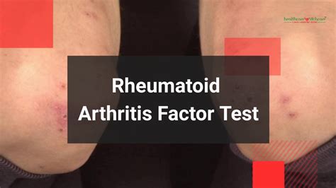 What Is Rheumatoid Arthritis Factor Test Why Ra Factor Test Advised