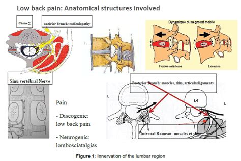 Peripheral Nerve Stimulation In Refractory Neuropathic Low Back Pain