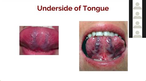 art of ayurveda tongue diagnosis 6 of 9 under the tongue sublingual veins youtube