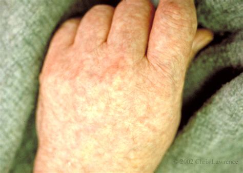Livedo Reticularis Of Hand In Multiple Myeloma With Monoclonal