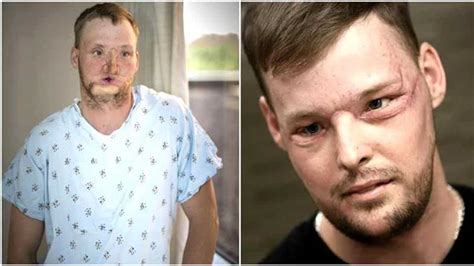 21 Before And After Facial Transplant Images Wtf Gallery Ebaum S World