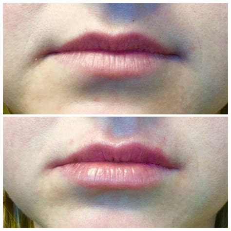 Beautiful Lips Gorgeous Lip Enhancement Facial Rejuvenation Holiday