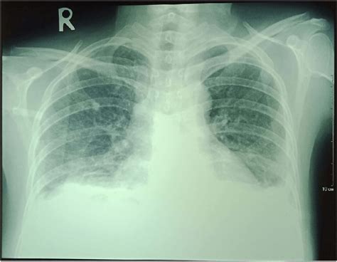 Chest X Ray Showing Bilateral Pleural Effusion In Lungs Download