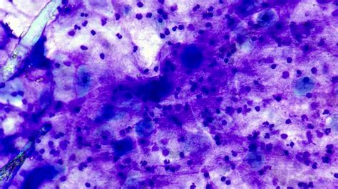 Prostate Abscess Cytology Youtube