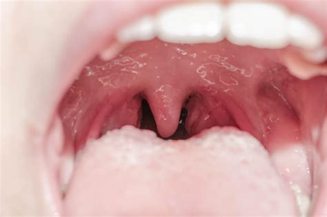¿qué Es La Uvulitis Y Por Qué Puede Ocurrir Mejor Con Salud