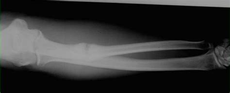 Nonunion of Ulna Fracture on X-ray - X Rays Case Studies ...