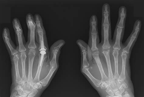 Hand Osteoarthritis