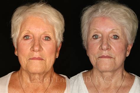 Deep Plane Facelift Before And After Photos Ennis Plastic Surgery In