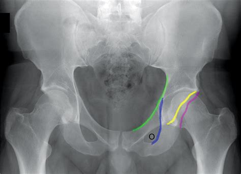 Classification Of Common Acetabular Fractures Radiographic And Ct
