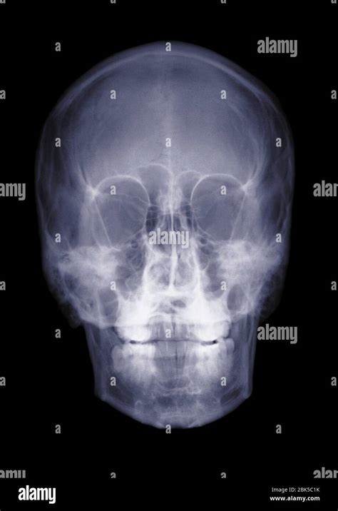 Human Skull X Ray Stock Photo Alamy