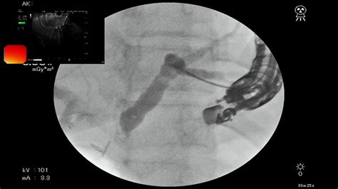 Eus Guided Transgastric Antegrade Biliary Drainage After Failed Ercp
