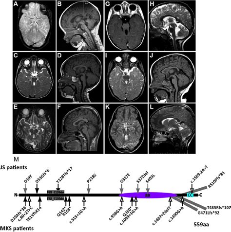 Mri Fi Ndings And Mutations In Individuals With Mks1 Related Joubert