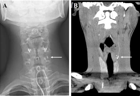 Barium Esophagography A And Ct Coronal Scan B Showed Pyriform Sinus