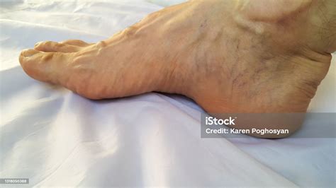 Leg Varicose Veins Phleborism Thrombophlebitis Red And Blue Capillaries