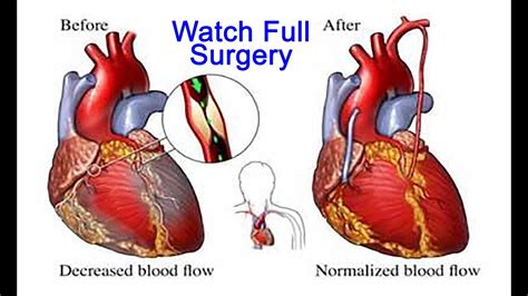 Minimally Invasive Coronary Artery Surgery Micas Open Heart Surgery