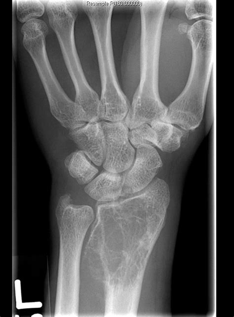 Racgp Painful Swollen Wrist A Case Study