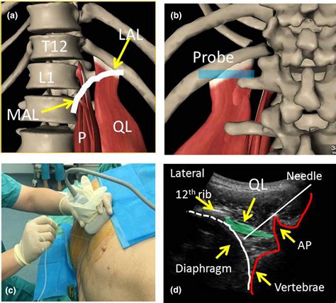 A Transverse Approach For Ultrasound‐guided Anterior Quadratus Lumborum