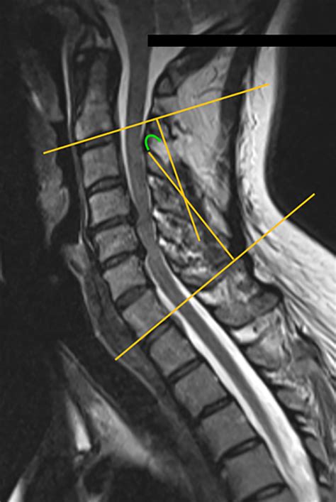 Abnormal Cervical Spine Mri