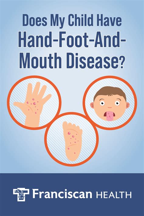 Hand Foot Mouth Disease Symptoms Tim Dyer