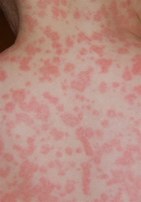 Amoxicillin Rash Symptoms Causes Pictures Treatment