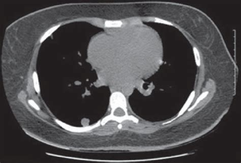 Contrast Enhanced Ct Of The Chest Acquired During Follow Up Showing