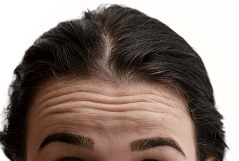 Forehead Lines Treatment And Preventation Options